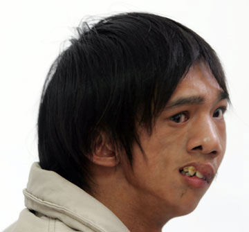 25岁小伙患怪病左脸是帅哥右脸象老头(组图)