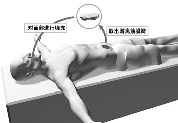 25岁小伙患怪病左脸是帅哥右脸象老头(组图)