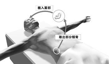 25岁小伙患怪病左脸是帅哥右脸象老头(组图)