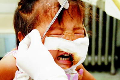 4岁女童被狼狗撕开半边脸 没钱放弃住院治疗(