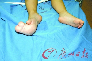 女孩脚长巨大并趾 类似病症全球仅60余例(图)_