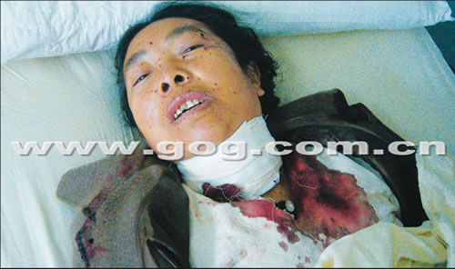 50岁妇女咽喉部<em>插</em>水果刀 深达6.5公分原因不明