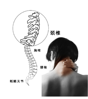 如颈椎病发病率最高的神经根型颈椎病
