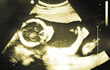 胎儿在腹中竖起大拇指