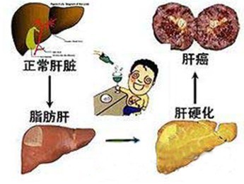 温州建国医院肝病治疗中心介绍脂肪肝走向图