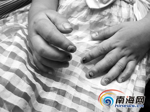 海南5岁女孩寄养1月遭虐待 多处骨折<em>处女膜</em>破