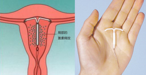 含孕激素的宫内节育器,作用示意图(左)和实物(右)