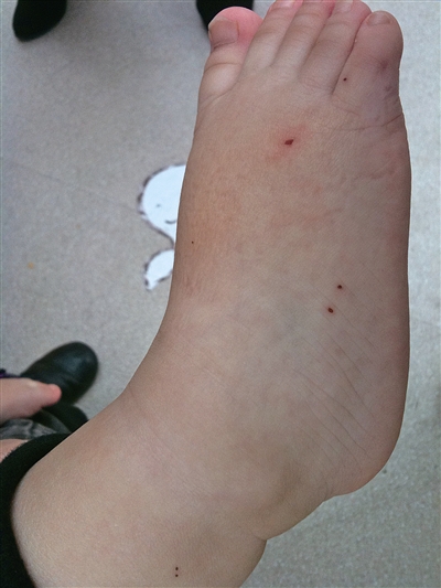 脚背上有七八个小伤疤 2岁女童“血孔疑云”