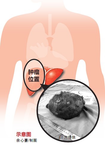肝脏长出一个排球+这么大的肿瘤是怎么长成