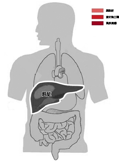 附二医体检报告分析出炉 脂肪肝门诊二成是瘦子