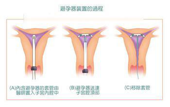 <em>女人</em>最舒服的避孕方式排行_生活提醒_温州网