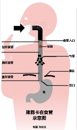 再加上食管和气管紧挨着,异物不及时取出的话,水肿的食管可能挤压气管