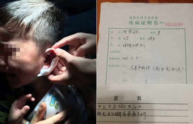 福建4岁男童耳朵被幼师用订书机钉穿