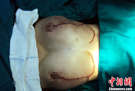 海南<em>16岁</em>巨乳症<em>少女</em> 切除乳房2450克_巨乳 