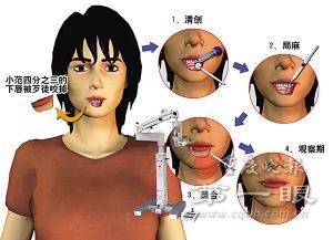 十余民警摸黑找回残唇 显微镜下两小时<em>再植</em>成