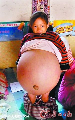 <em>大肚女孩</em> 胡云星:10万网民爱心接力 病情确诊治