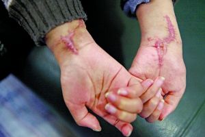 男童双手遭养母砍断接手后失去活动功能图