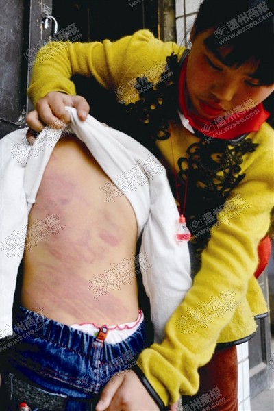 7岁女孩不做作业遭木藤抽打 亲爸爸怎忍心下重手